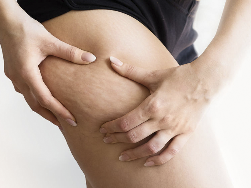 <a><strong>¿Qué es la celulitis?</strong></a>